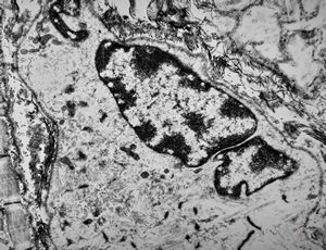 F,32y. | muscular dystrophy - regeneratiing muscle cell F,32y. | muscular dystrophy - regeneratiing muscle cell